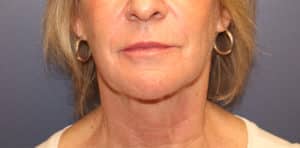 Before Image: Necklift