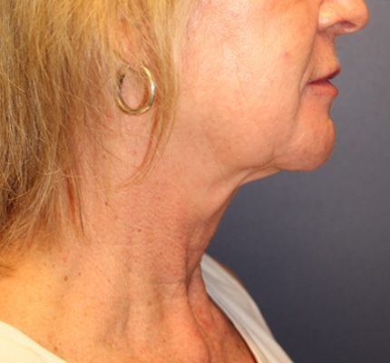Before Image: Necklift - right-side