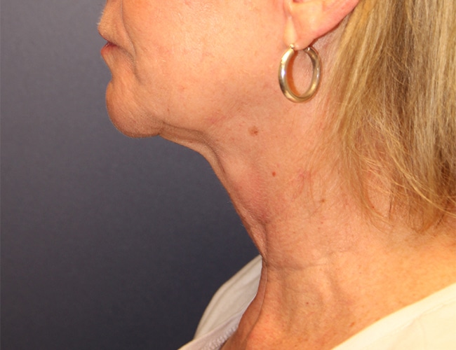 Before Image: Necklift - left-side