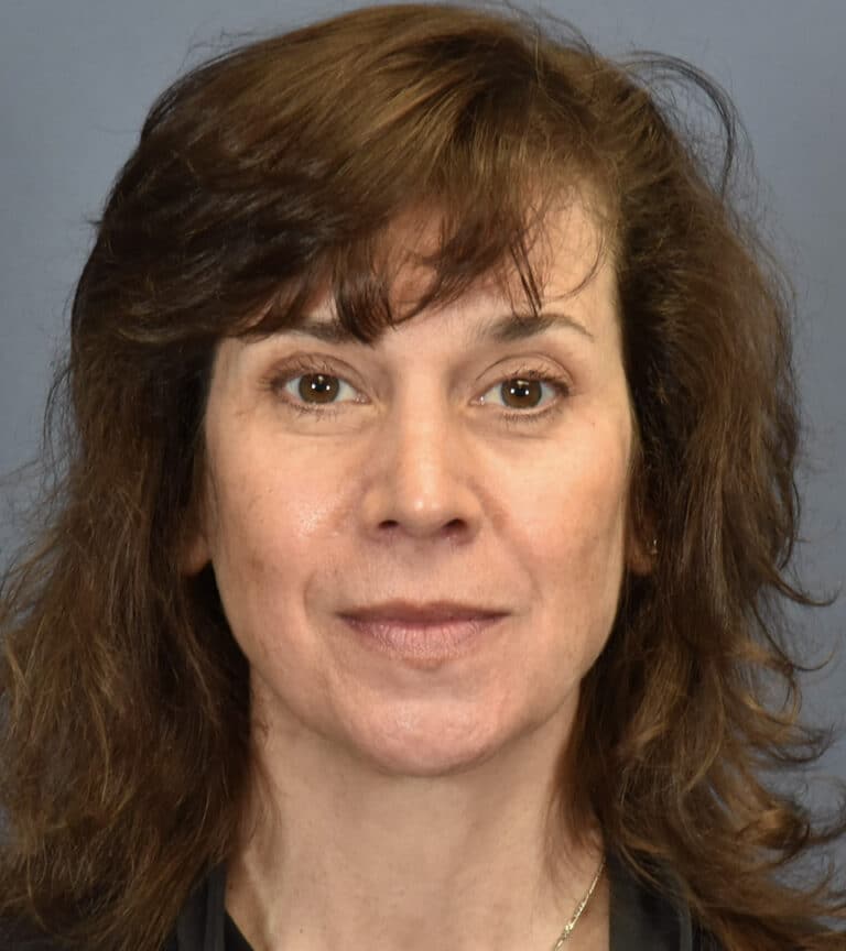 After Image: Rhinoplasty - front