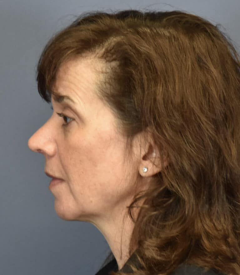 After Image: Rhinoplasty - left-side