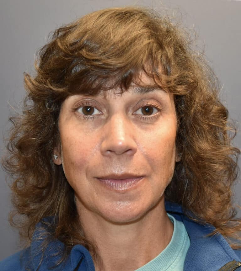Before Image: Rhinoplasty - front
