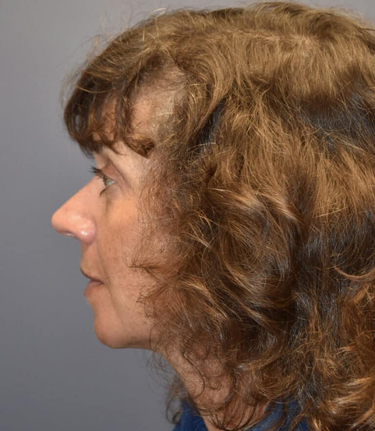 Before Image: Rhinoplasty - left-side