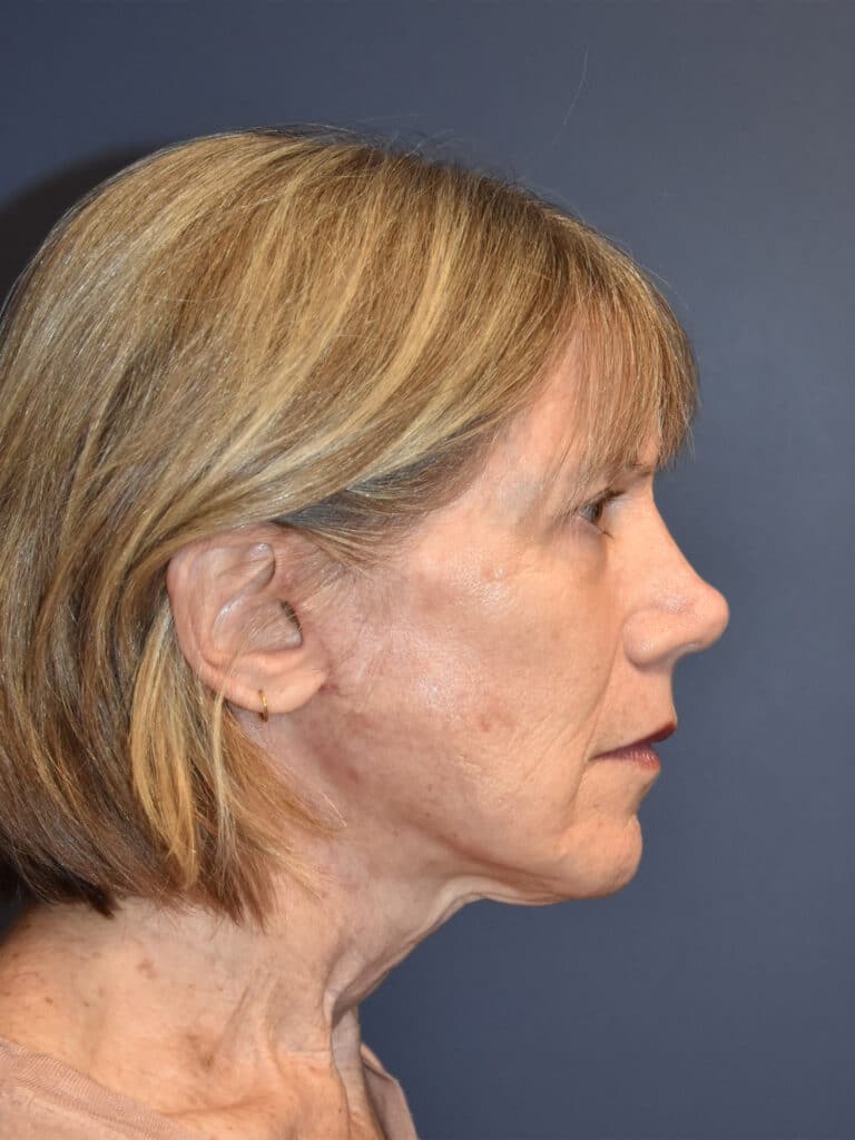 After Image: Facelift and Neck Lift - right-side