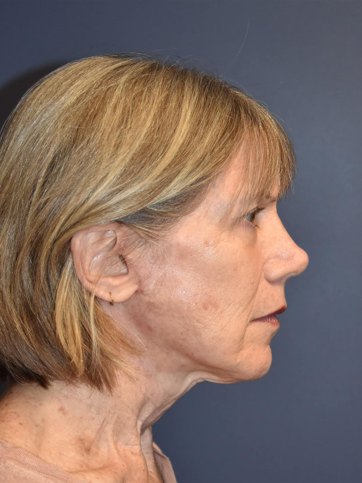 After Image: Facelift and Neck Lift - right-side