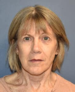 After Image: Facelift and Neck Lift