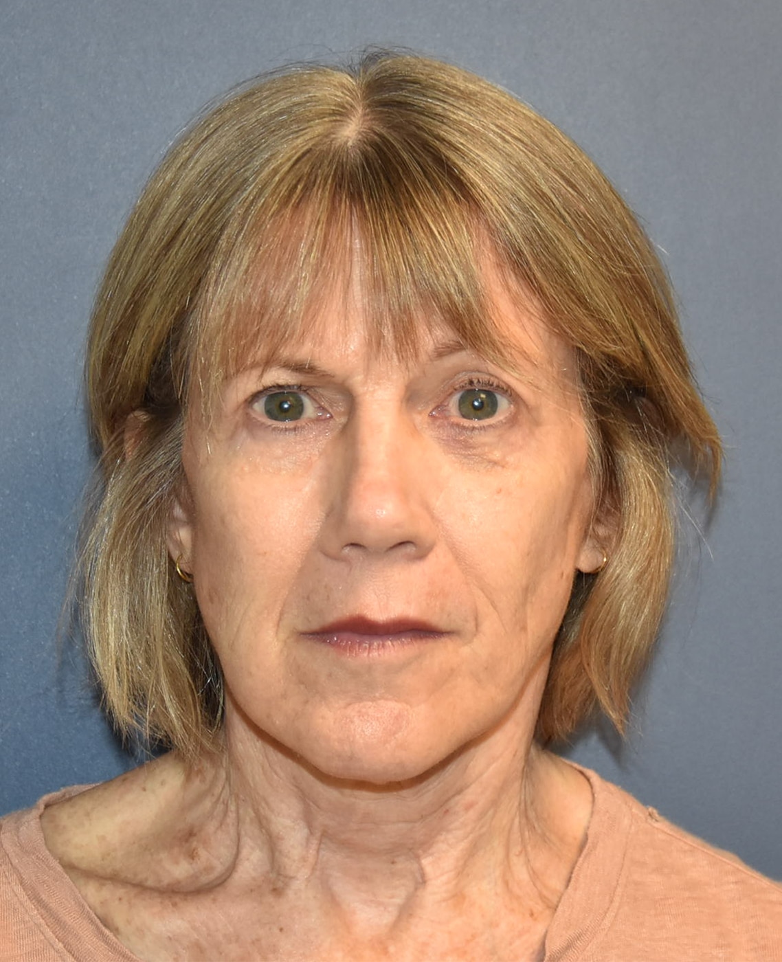 After Image: Facelift and Neck Lift - front