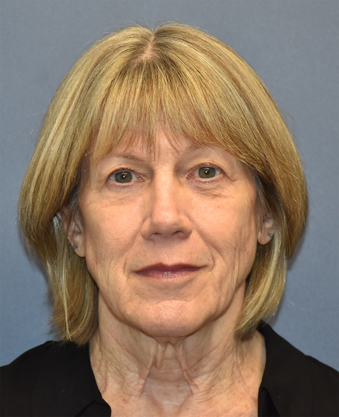 Before Image: Facelift and Neck Lift - front