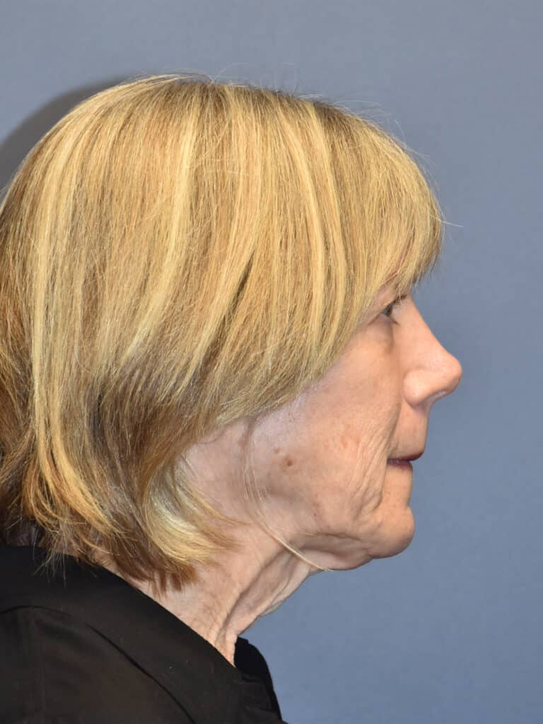 Before Image: Facelift and Neck Lift - right-side