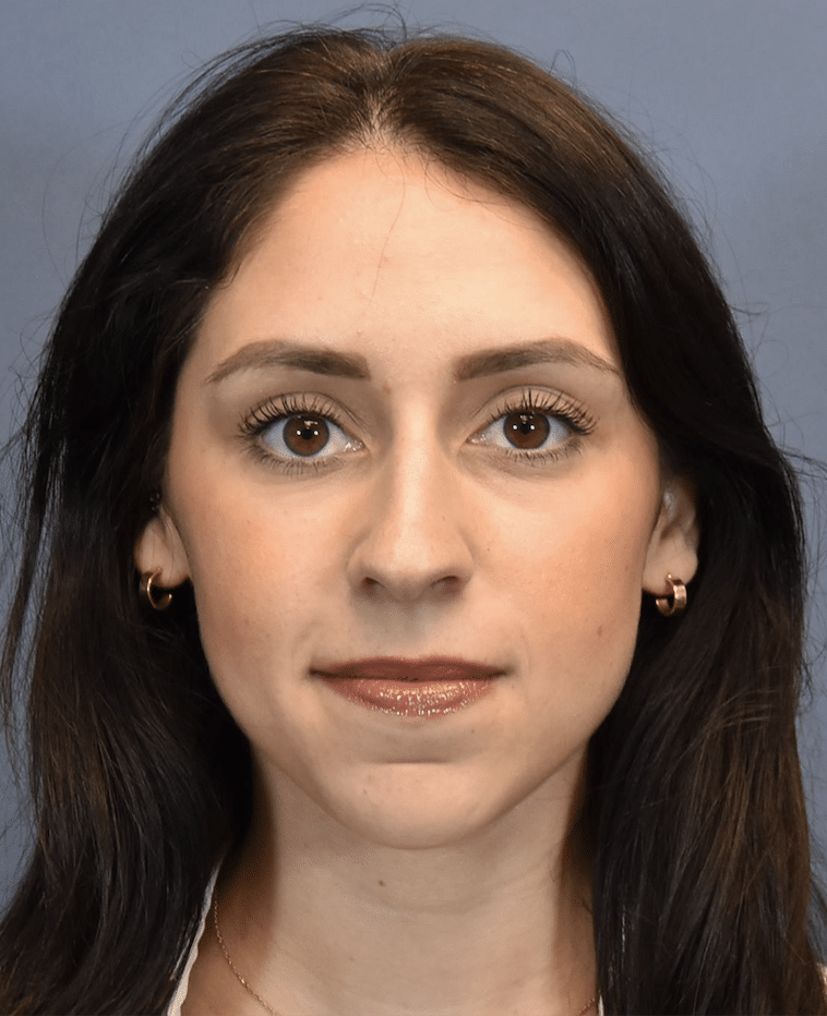 After Image: Rhinoplasty - front