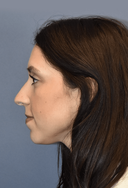 After Image: Rhinoplasty - left-side