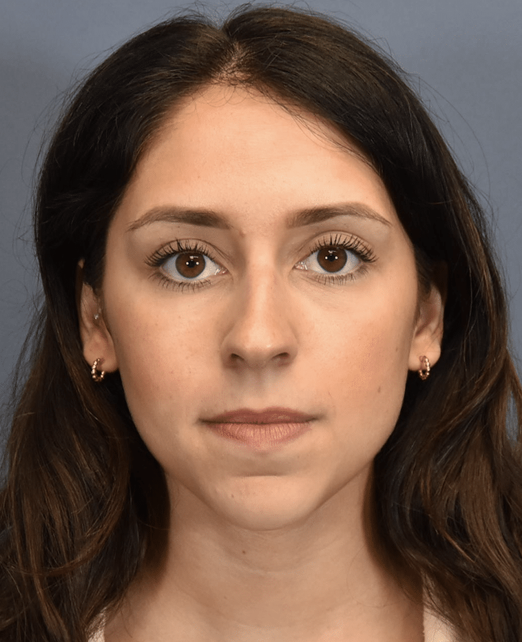 Before Image: Rhinoplasty - front