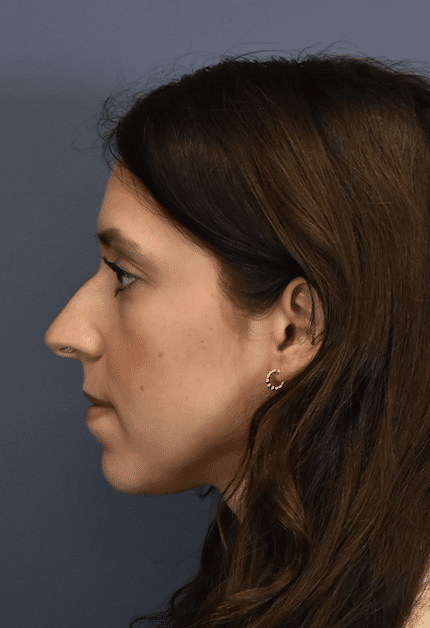 Before Image: Rhinoplasty - left-side