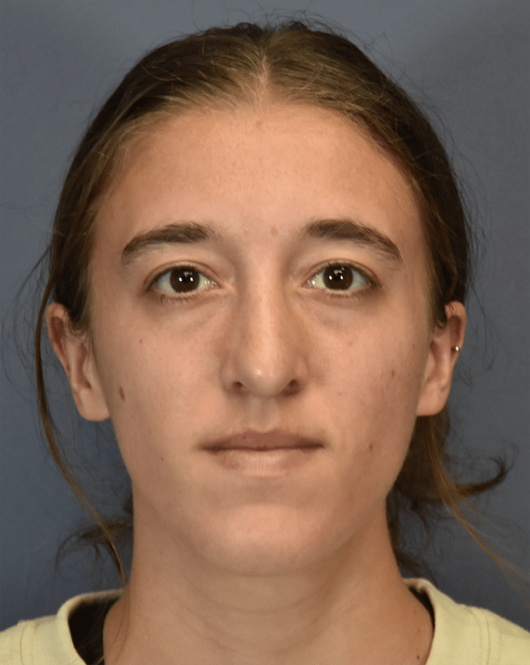 After Image: Rhinoplasty - front