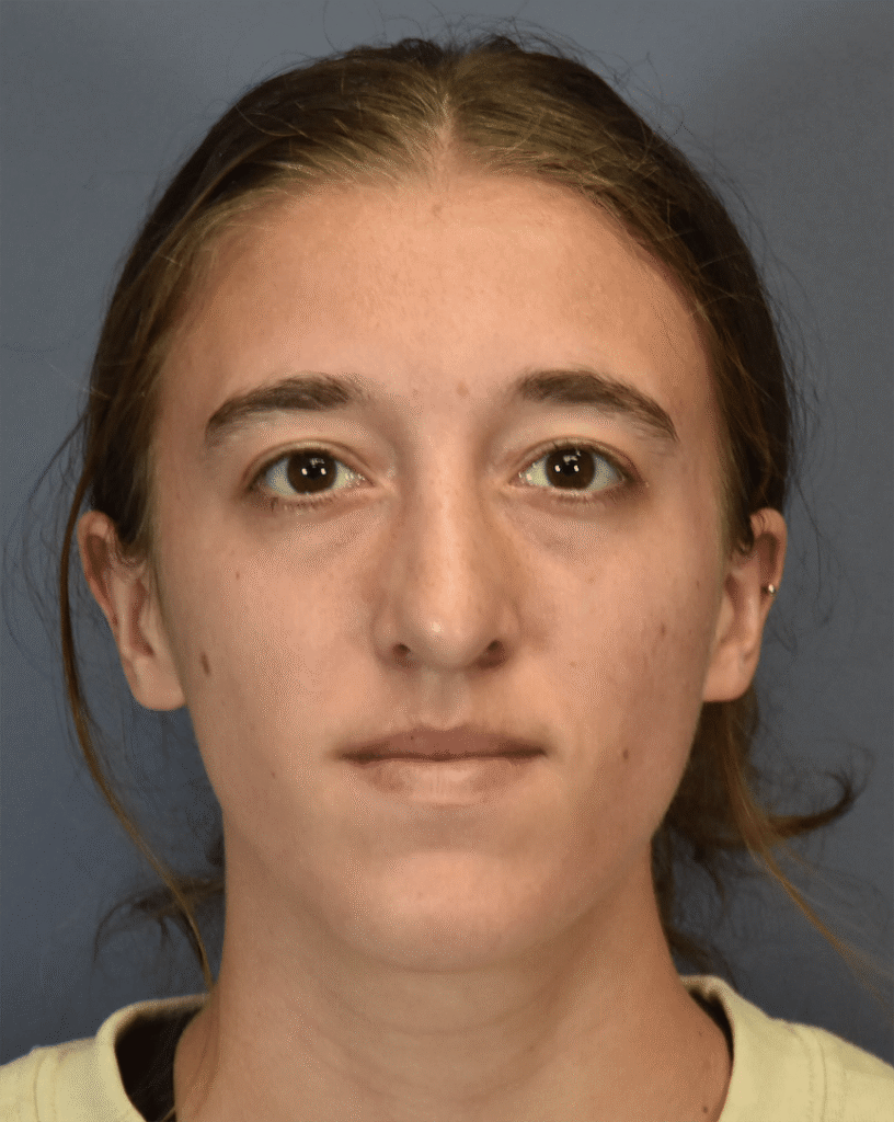 After Image: Rhinoplasty - front