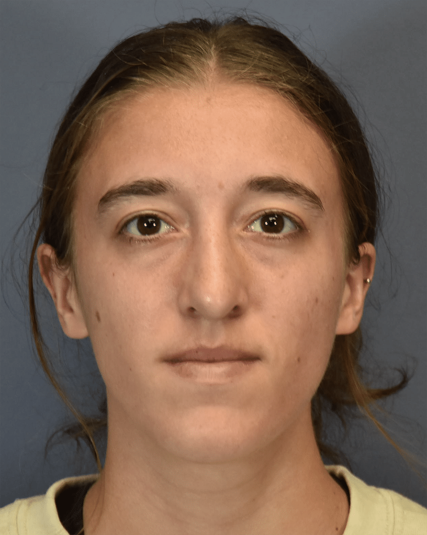 After Image: Rhinoplasty - front