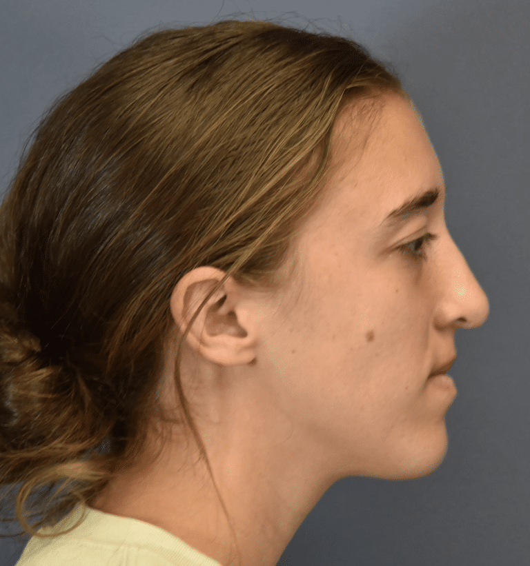 After Image: Rhinoplasty - right-side