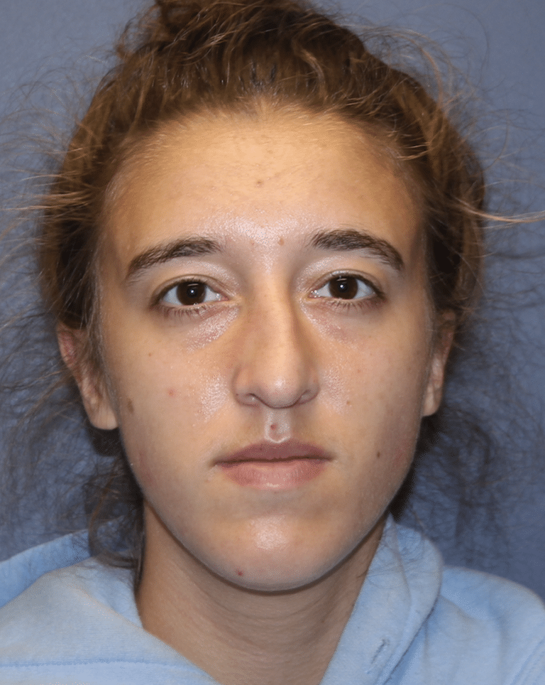 Before Image: Rhinoplasty - front