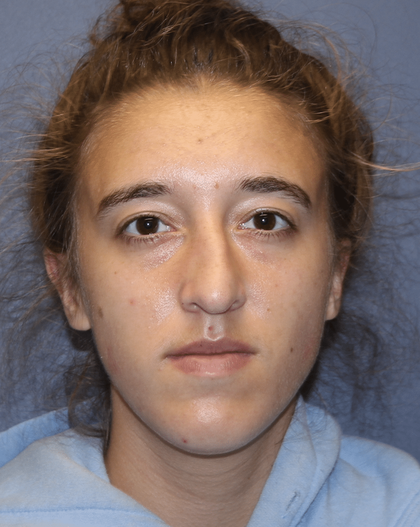Before Image: Rhinoplasty - front