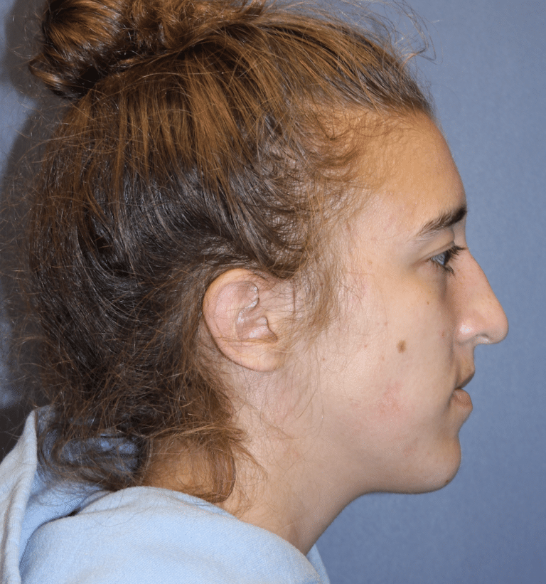 Before Image: Rhinoplasty - right-side