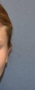 After Image: Otoplasty