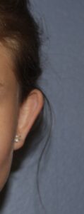 Before Image: Otoplasty