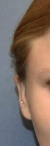 After Image: Otoplasty