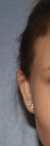 Before Image: Otoplasty