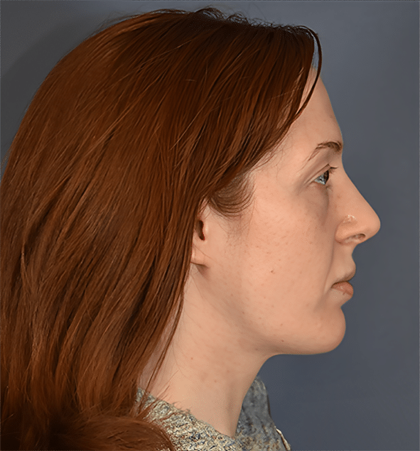 After Image: Rhinoplasty - right-side