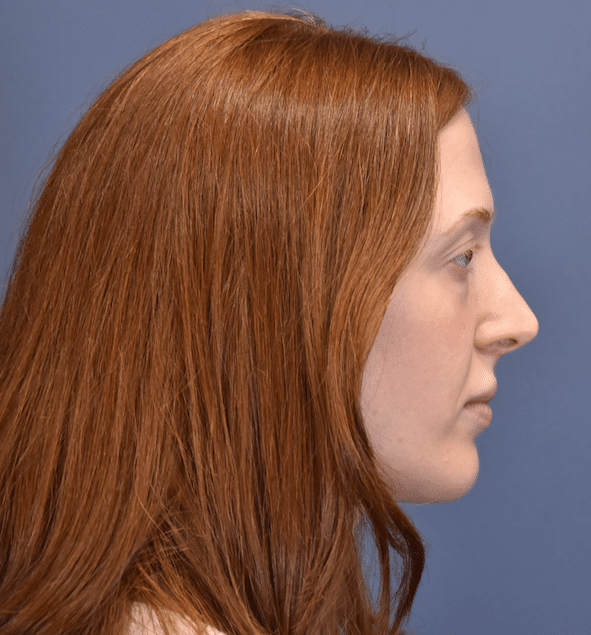 Before Image: Rhinoplasty - right-side