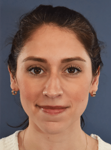 After Image: Rhinoplasty