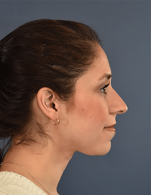 After Image: Rhinoplasty - right-side
