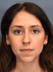 Before Image: Rhinoplasty