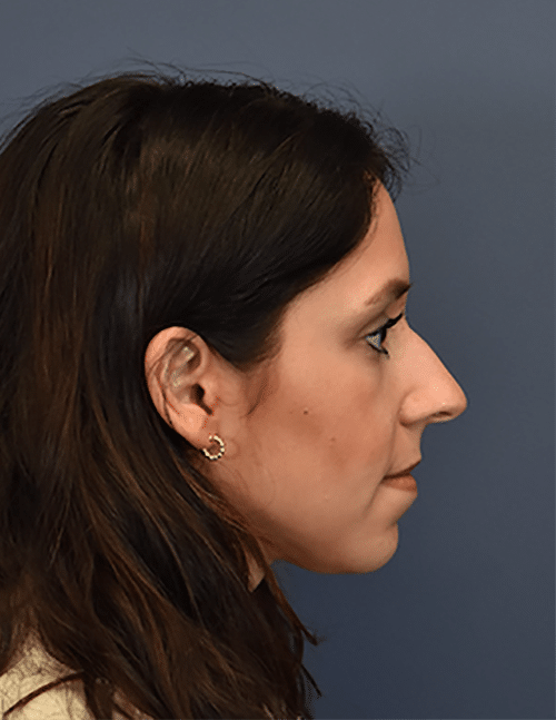 Before Image: Rhinoplasty - right-side