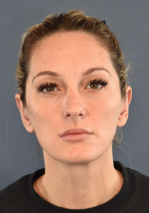 After Image: Otoplasty