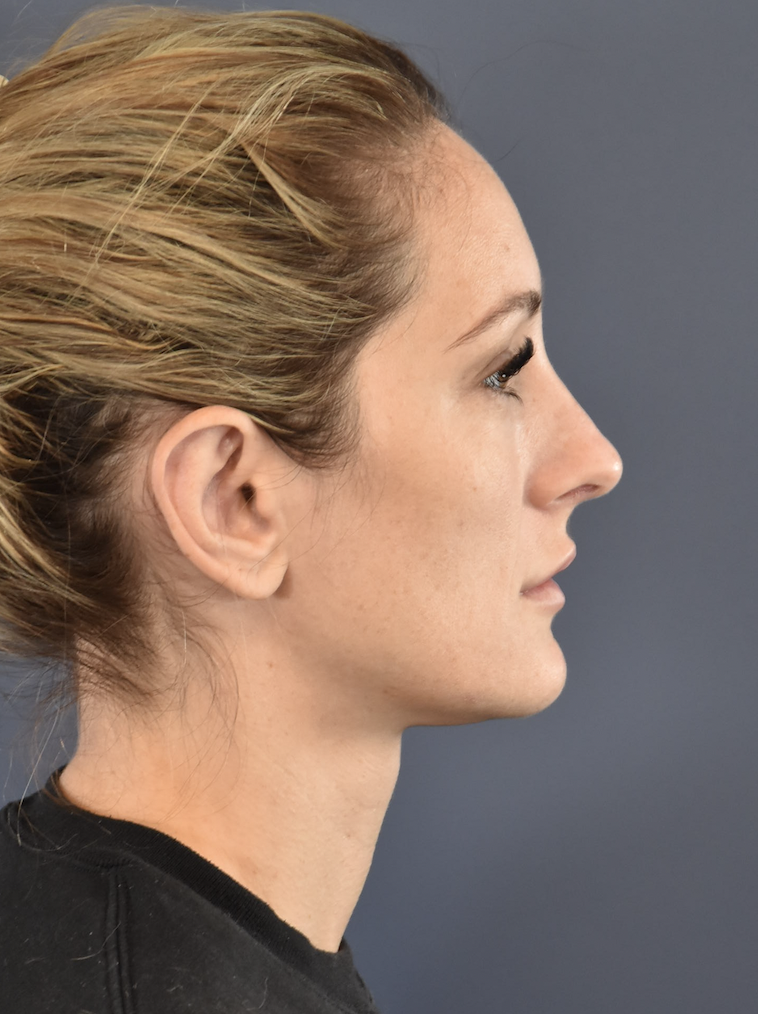 After Image: Otoplasty - right-side