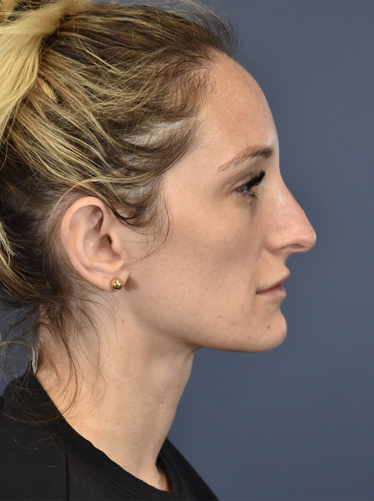Before Image: Otoplasty - right-side