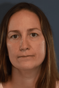 After Image: Rhinoplasty