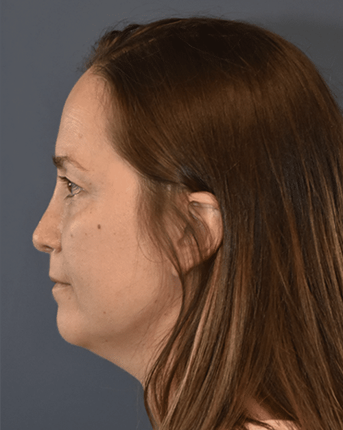 After Image: Rhinoplasty - left-side