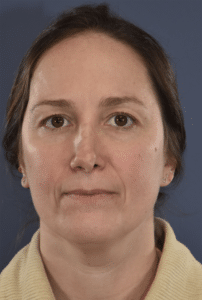 Before Image: Rhinoplasty