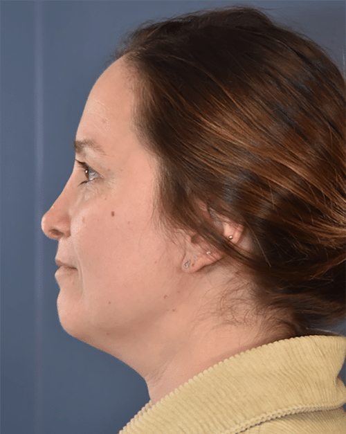 Before Image: Rhinoplasty - left-side