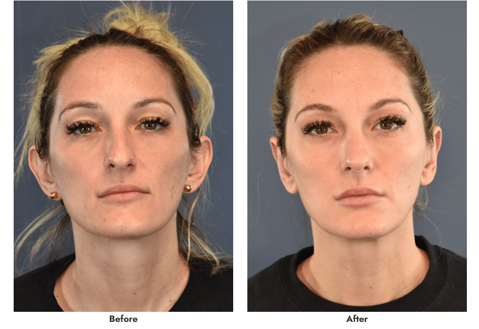 Otoplasty Case 5767 Boston Plastic Surgery