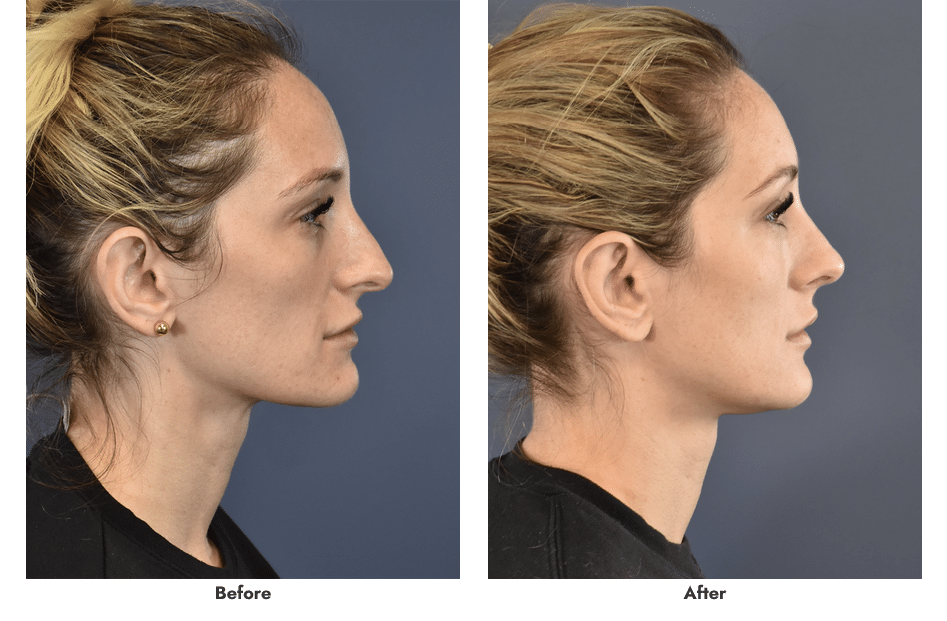 Rhinoplasty Case 5767 Boston Plastic Surgery