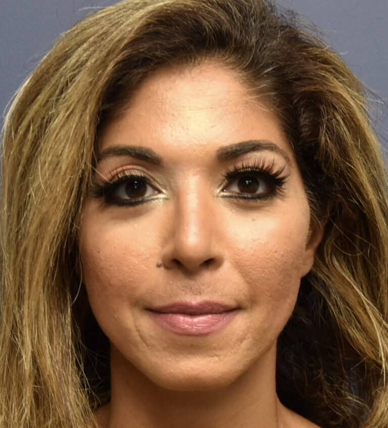 After Image: Rhinoplasty - front