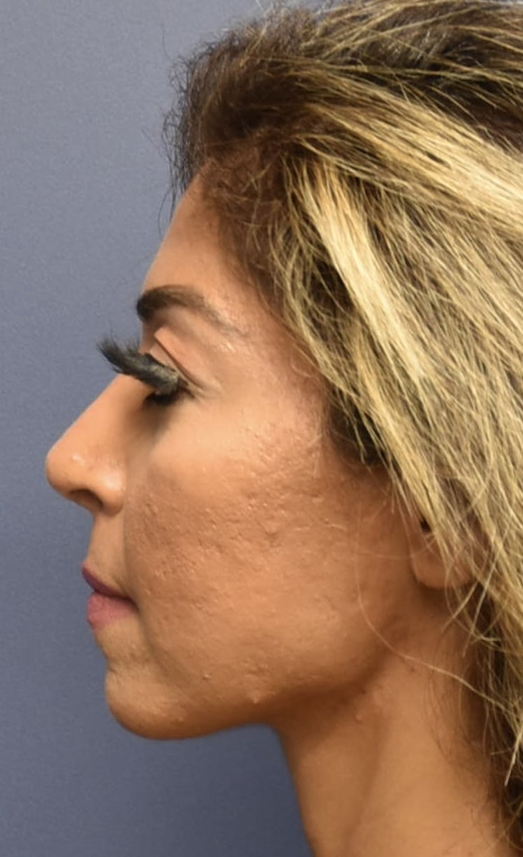 After Image: Rhinoplasty - left-side