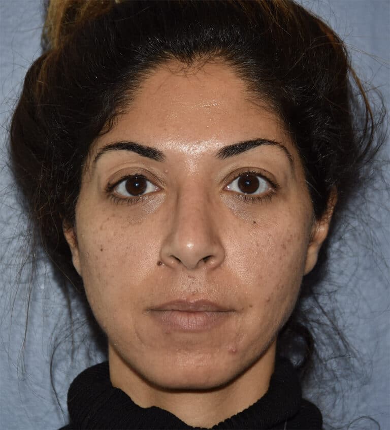 Before Image: Rhinoplasty - front