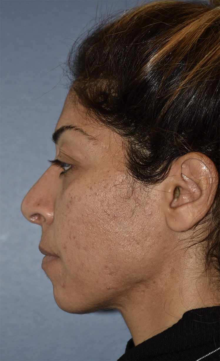 Before Image: Rhinoplasty - left-side