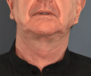 After Image: Neck Lift