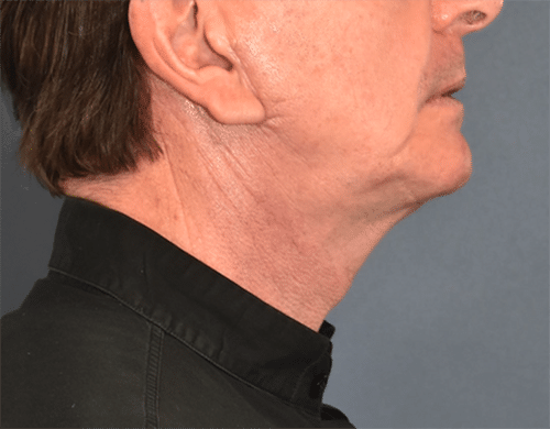 After Image: Neck Lift - right-side