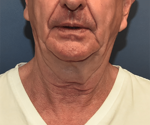 Before Image: Neck Lift - front